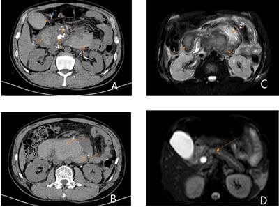 Spontaneous Rupture and Hemorrhage of WON: A Case Report